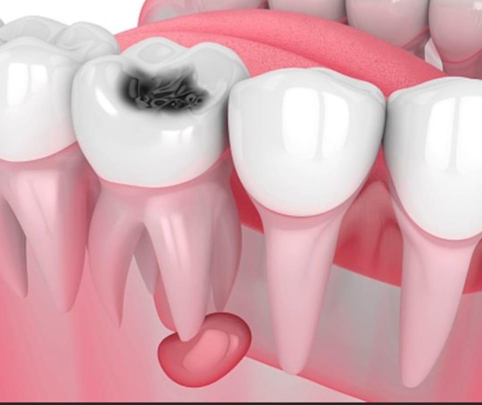 Oral cyst, tumor surgery Oral Cyst Tumor Surgery