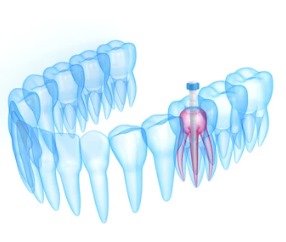 Post and core therapy Post And Core Therapy