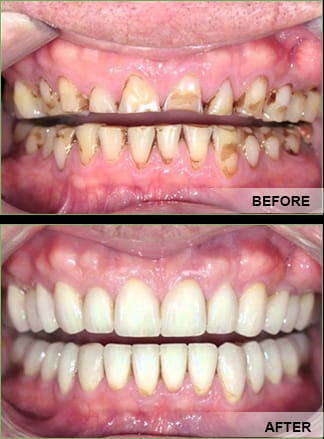 mouth rehabilation Mouth Rehabilation
