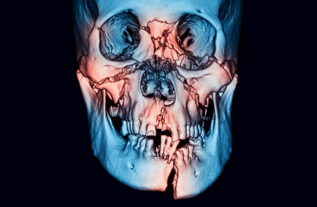 facial trauma