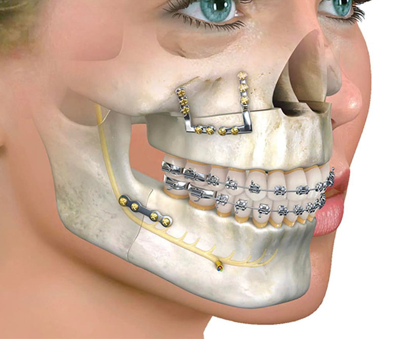 pinnacle oral surgery rockwall texas orthognathic surgery v2